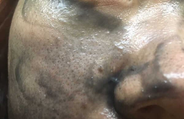 毛穴という毛穴に黒DUOが入り込んでます（C）サイゾーウーマン